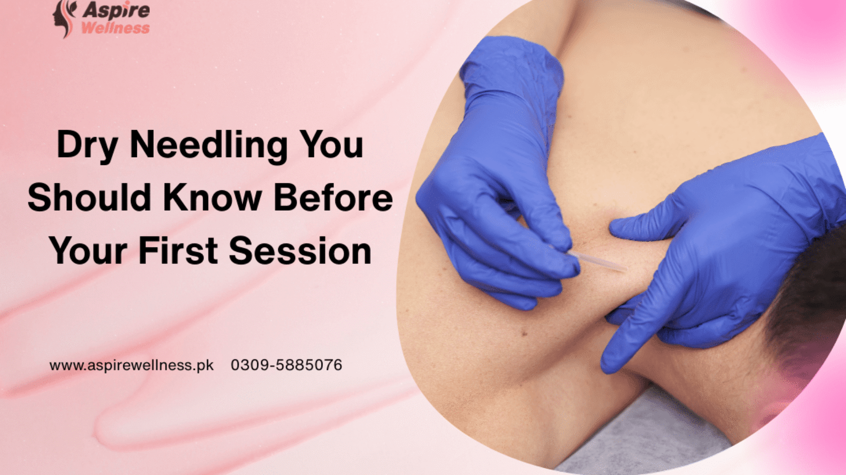 Dry Needling vs Hijama
