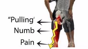 Hijama cupping therapy for Low back pain