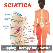 Hijama for Sciatica