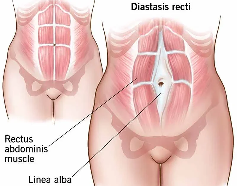 diastasis recti physiotherapy
